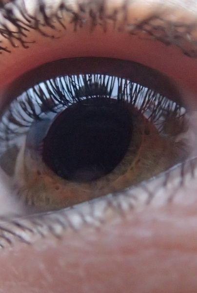 Glaucoma: ¿Qué es y cuáles son sus factores de riesgo?
